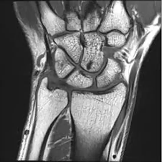 MRI Bilateral Wrist With Contrast
